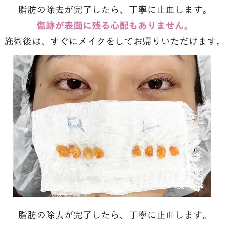 脂肪の除去が完了したら、丁寧に止血します。 傷跡が表面に残る心配もありません。 施術後は、すぐにメイクをしてお帰りいただけます。 コンタクトレンズも翌日からは通常通りご使用いただけますので、普段の生活にすぐにお戻りいただけます。