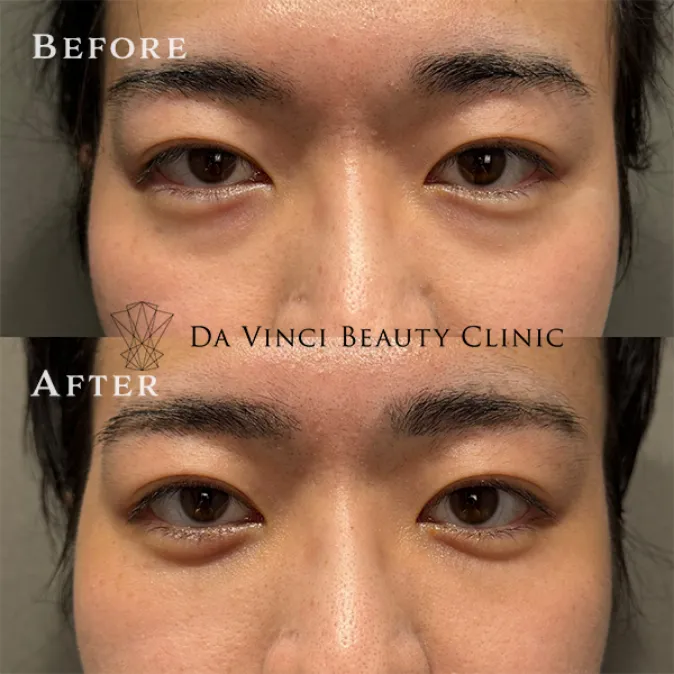 20代男性の切らないクマ取り症例写真。疲れ顔の原因となる目元のたるみを解消した事例紹介。