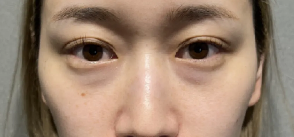 30代女性のクマ・目袋相談（術前）。渋谷のダヴィンチビューティークリニックでのクマ取り診察事例。