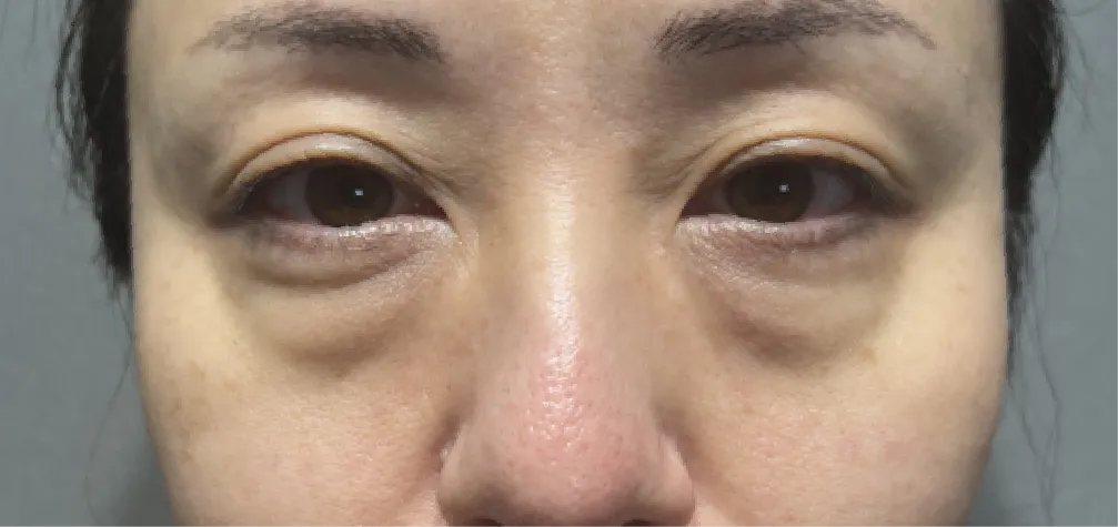 40代女性の目の下のたるみ・クマ術前写真。老け顔の原因である眼窩脂肪の突出を確認。