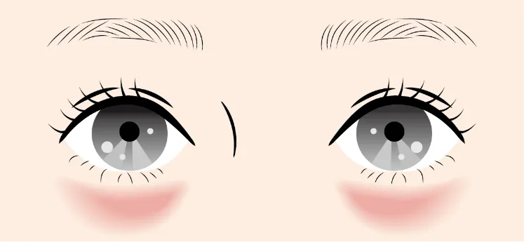 赤クマの原因を解説したイラスト図解。眼輪筋が皮膚に透けて赤く見えるメカニズム。