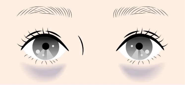 青クマの原因（血行不良）を解説したイラスト。毛細血管のうっ血が透けて見える仕組み。