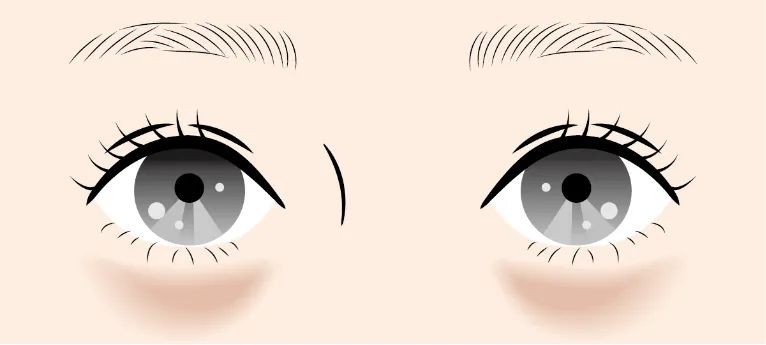 茶クマの原因（色素沈着）を解説した図解。摩擦や紫外線によるシミ・くすみの発生メカニズム。