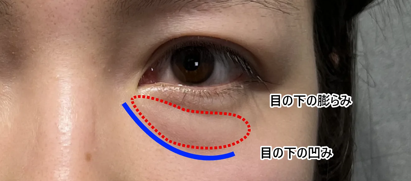 クマの治療例　施術前