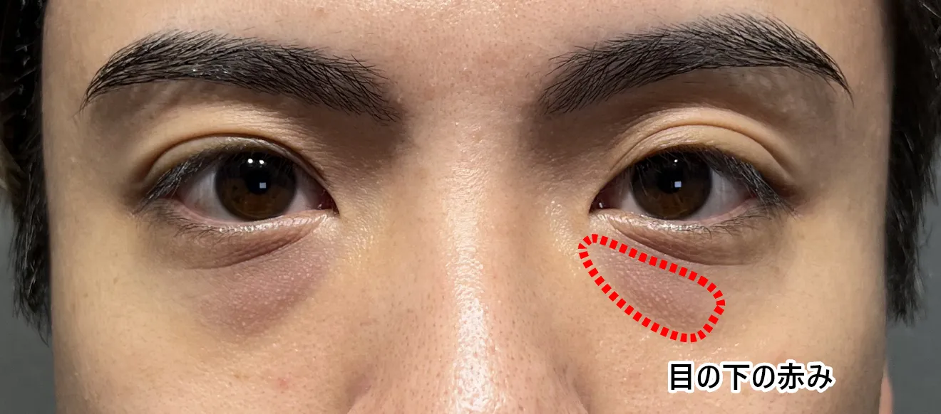 クマの治療例　施術前