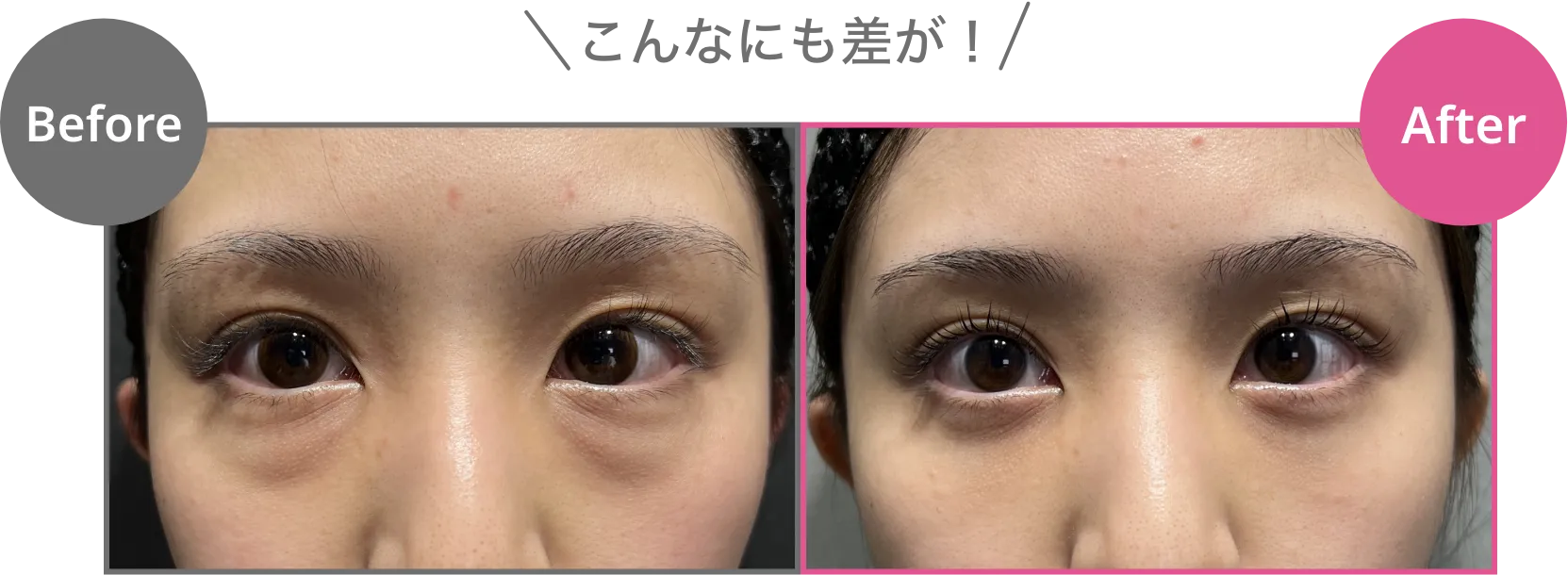 目の下にクマがある状態　通常の目元　こんなにも差が