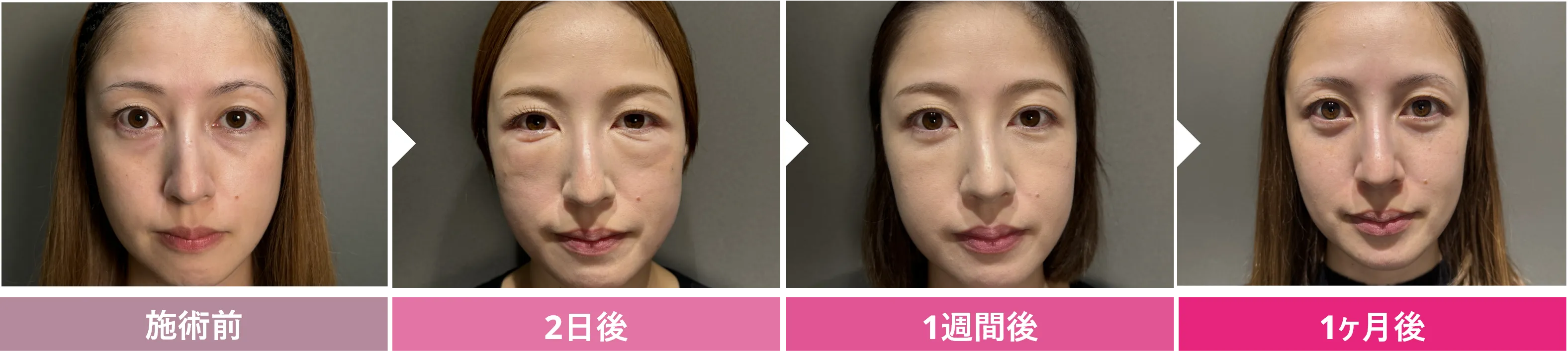 クマ取り＋脂肪注入 ダウンタイムの経過 症例1