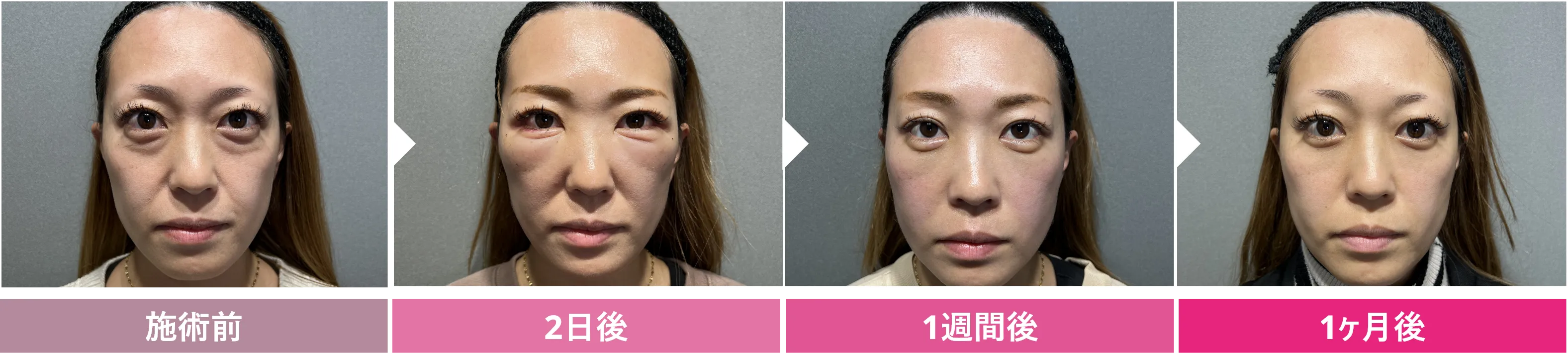 クマ取り＋脂肪注入　ダウンタイムの経過 症例2