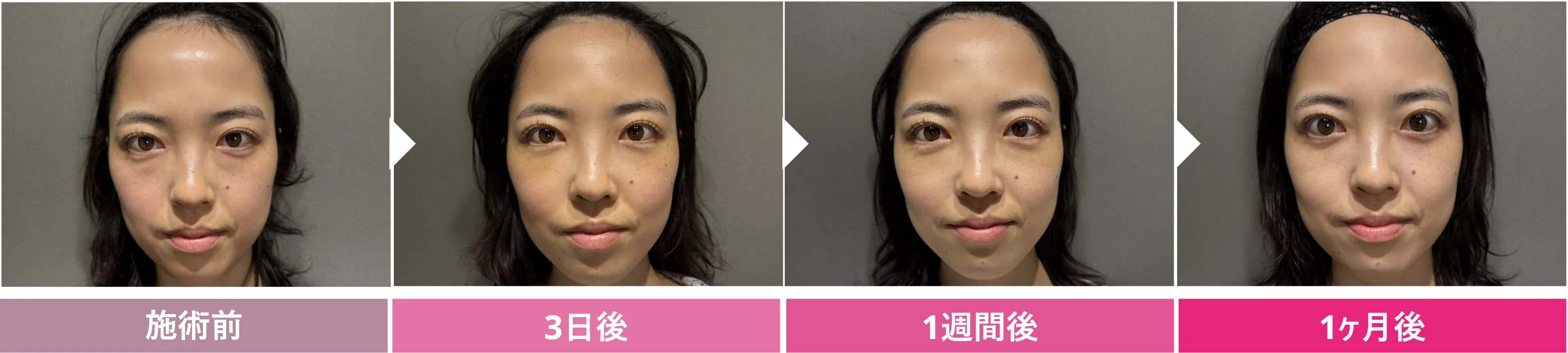 クマ取り＋脂肪注入　ダウンタイムの経過 症例1