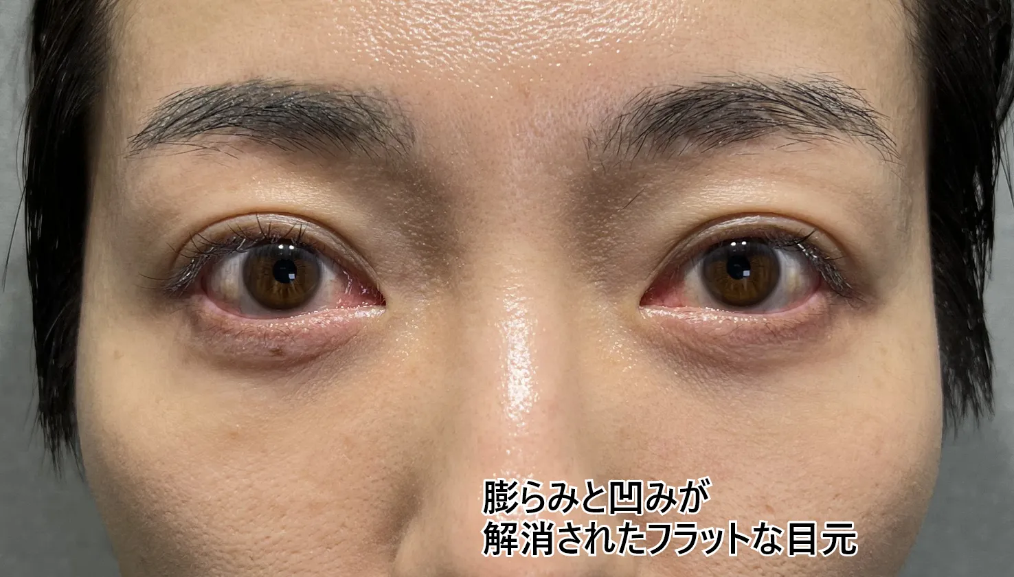 クマ取り＋脂肪注入　Before