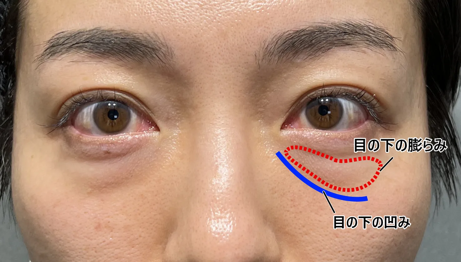 クマ取り＋脂肪注入　Before