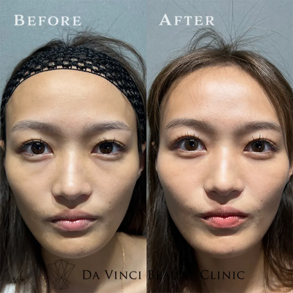 20代女性 目の下の切らないクマ取り+脂肪注入術前・術後の比較症例写真