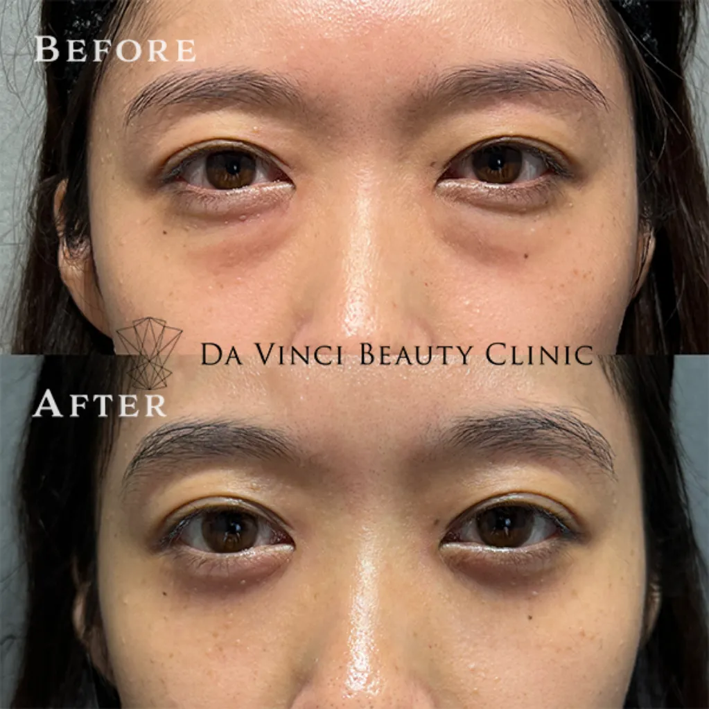 20代女性 目の下の切らないクマ取り+脂肪注入術前・術後の比較症例写真