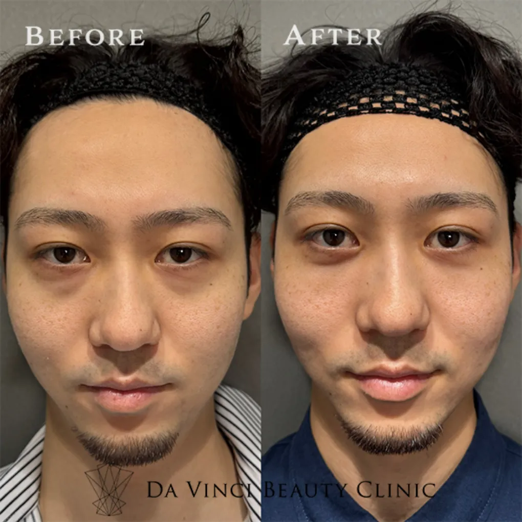 20代男性 目の下の切らないクマ取り+脂肪注入術前・術後の比較症例写真
