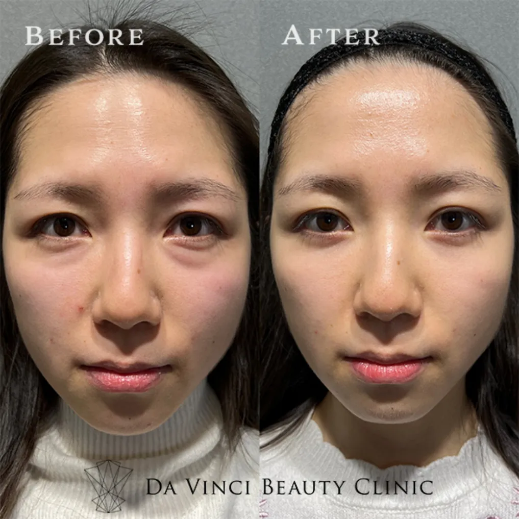 30代女性 目の下の切らないクマ取り+脂肪注入術前・術後の比較症例写真