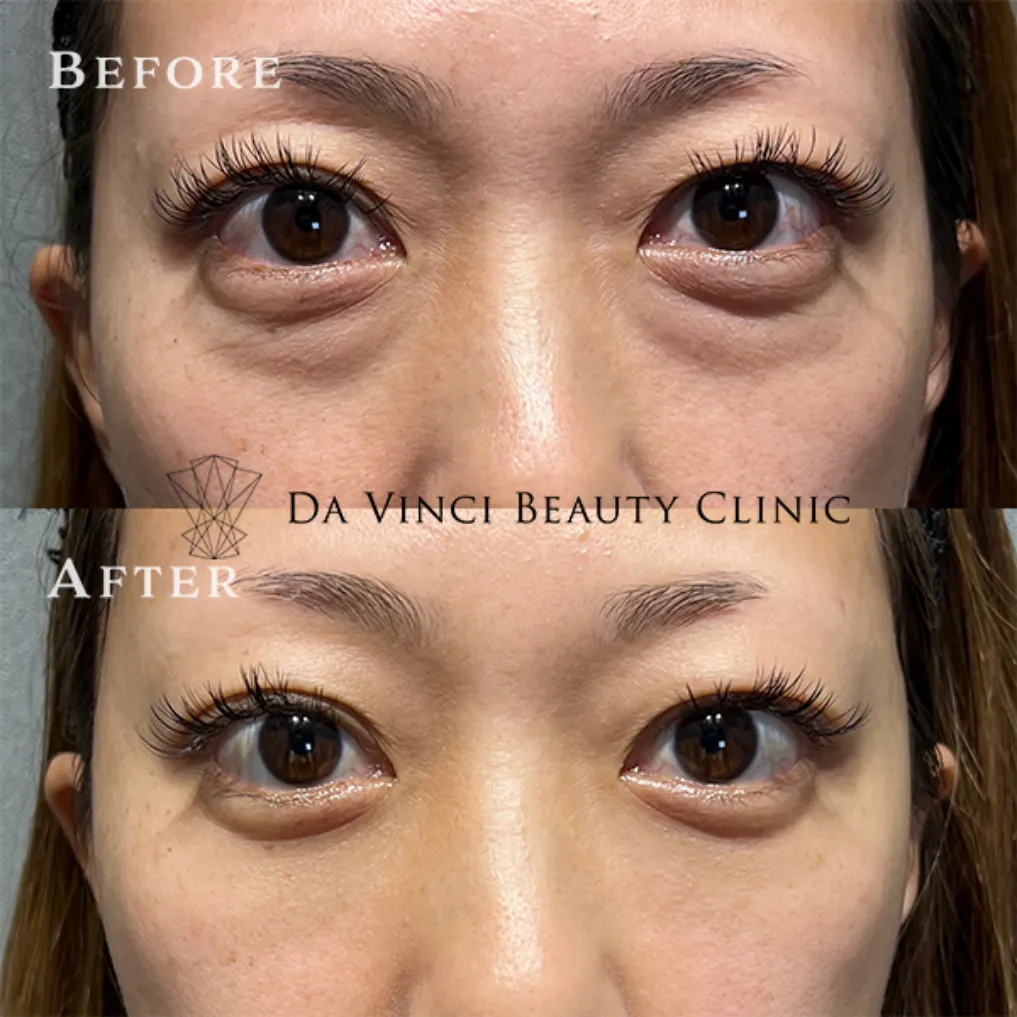 30代女性 目の下の切らないクマ取り+脂肪注入術前・術後の比較症例写真