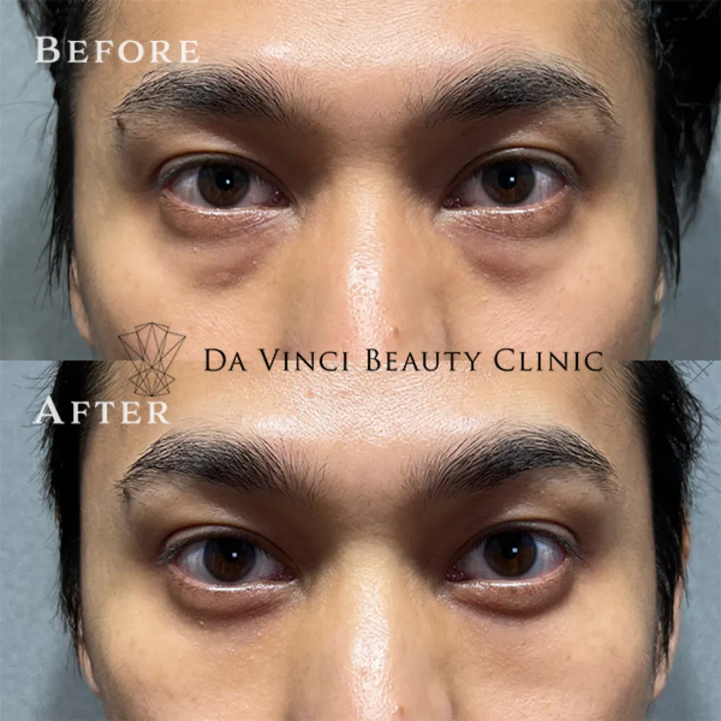 30代男性 目の下の切らないクマ取り+脂肪注入術前・術後の比較症例写真