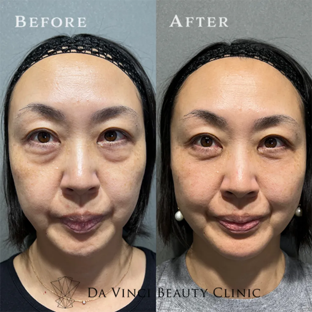 40~50代女性 目の下の切らないクマ取り+脂肪注入術前・術後の比較症例写真