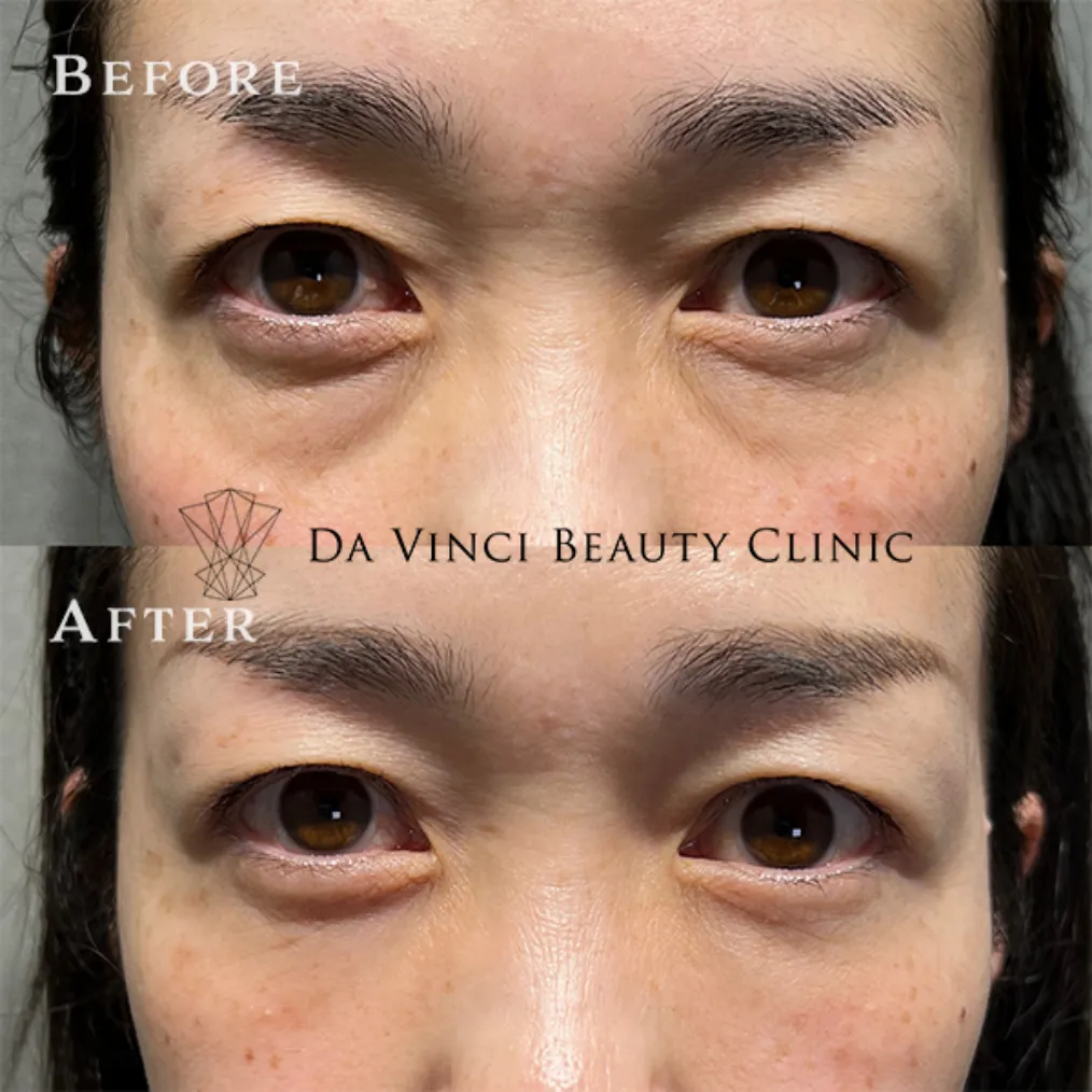 40~50代女性 目の下の切らないクマ取り+脂肪注入術前・術後の比較症例写真