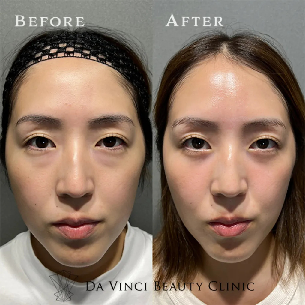 コンシーラーで隠れない20代特有の青くま・黒くまを根本改善した症例比較