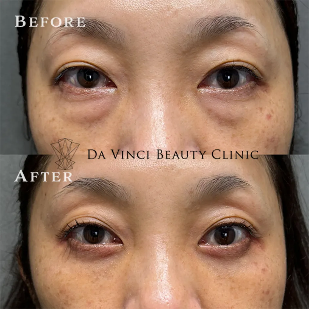 40代の深いクマ・ゴルゴ線を解消し、老け見えを改善する高度なクマ取り症例