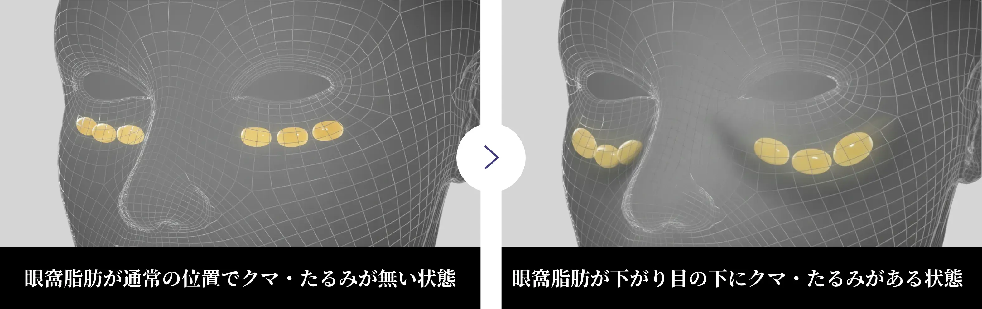 【図解】目の下のたるみ・眼窩脂肪の突出メカニズムと加齢によるクマの原因