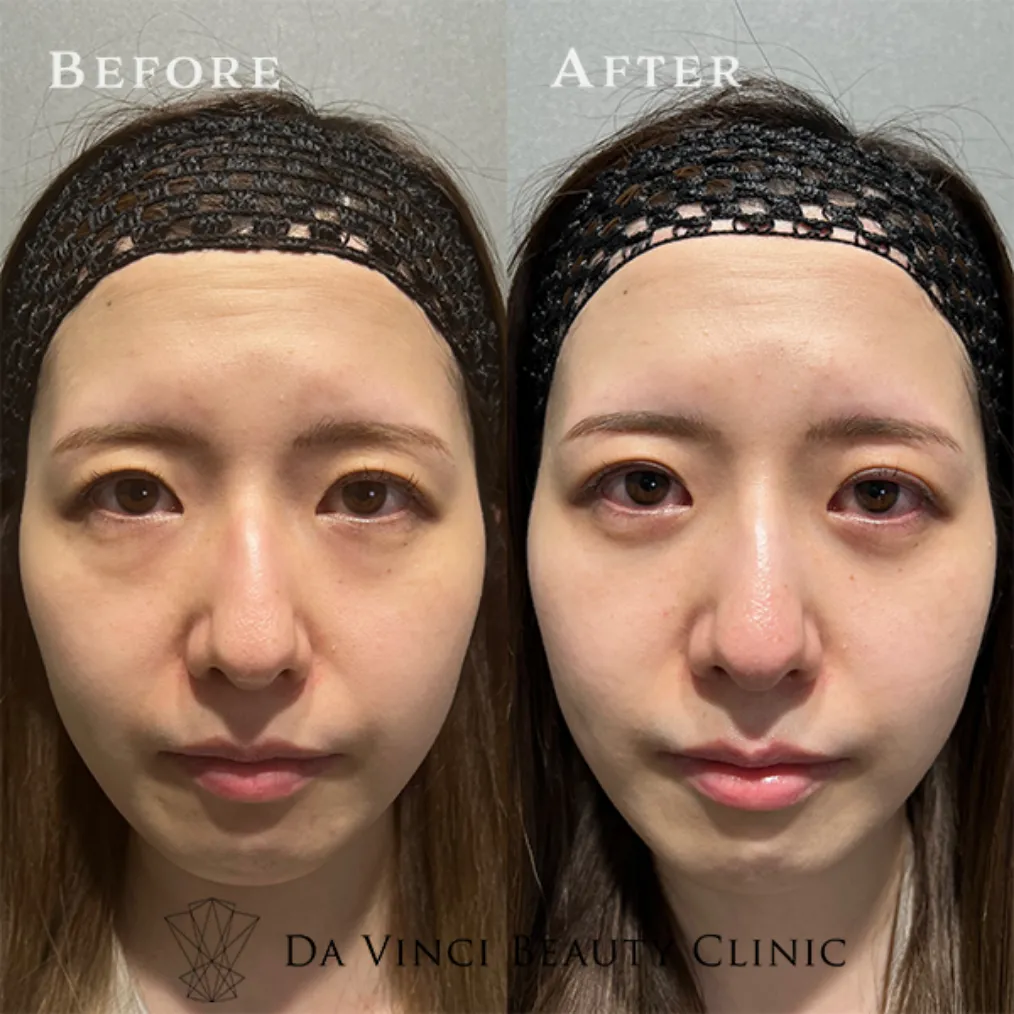 30代女性の目元の若返り・クマ取り施術による明るい目元の症例写真