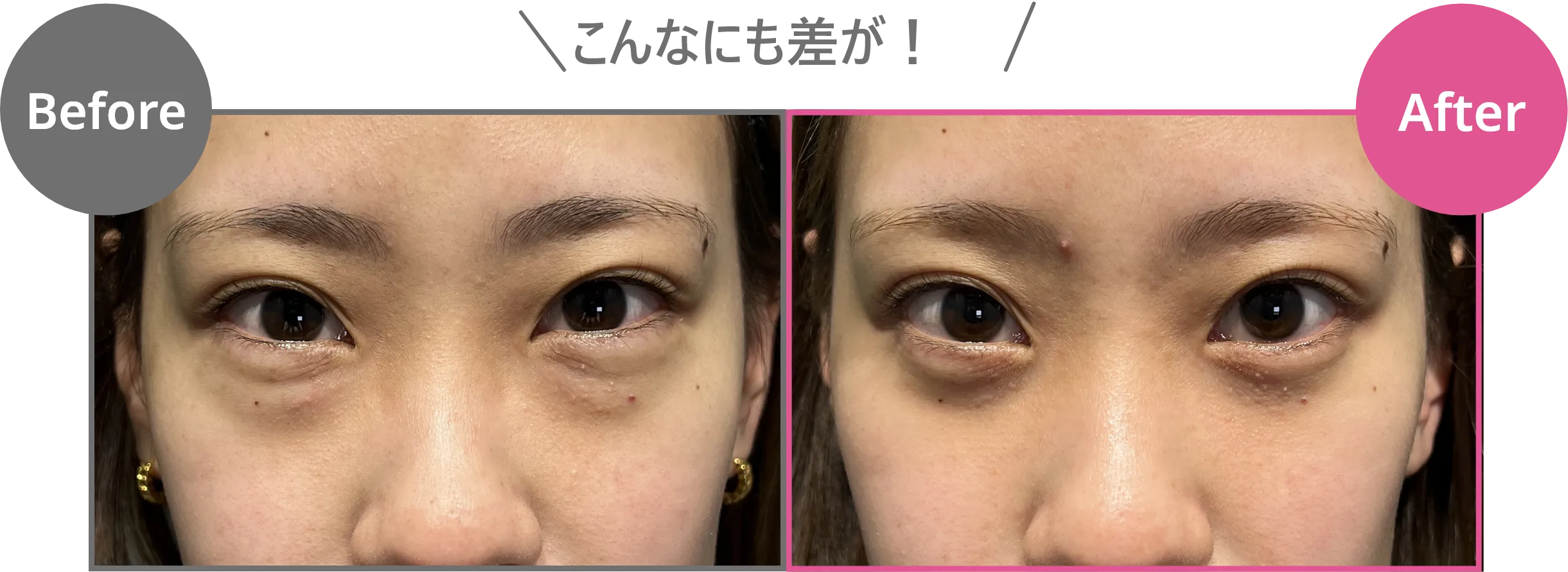 従来のクマ取りとダヴィンチクリニックの高度な術法（脂肪注入併用）の違い