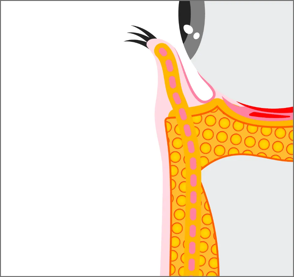 クマ取り治療の流れ：安全を考慮した清潔なオペ室での施術風景（ステップ03）