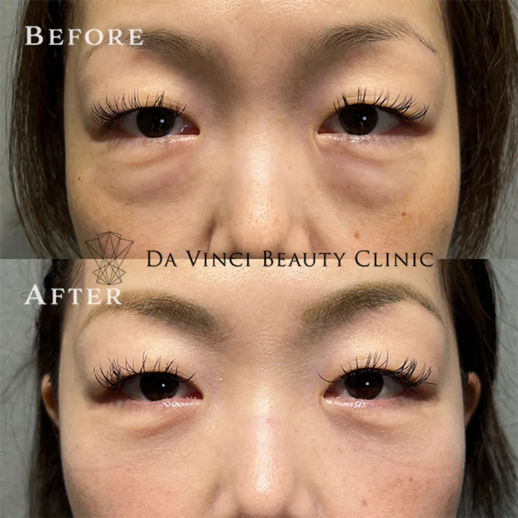 40代女性の目の下のたるみ・クマ改善（渋谷ダヴィンチクリニックの若返り症例）