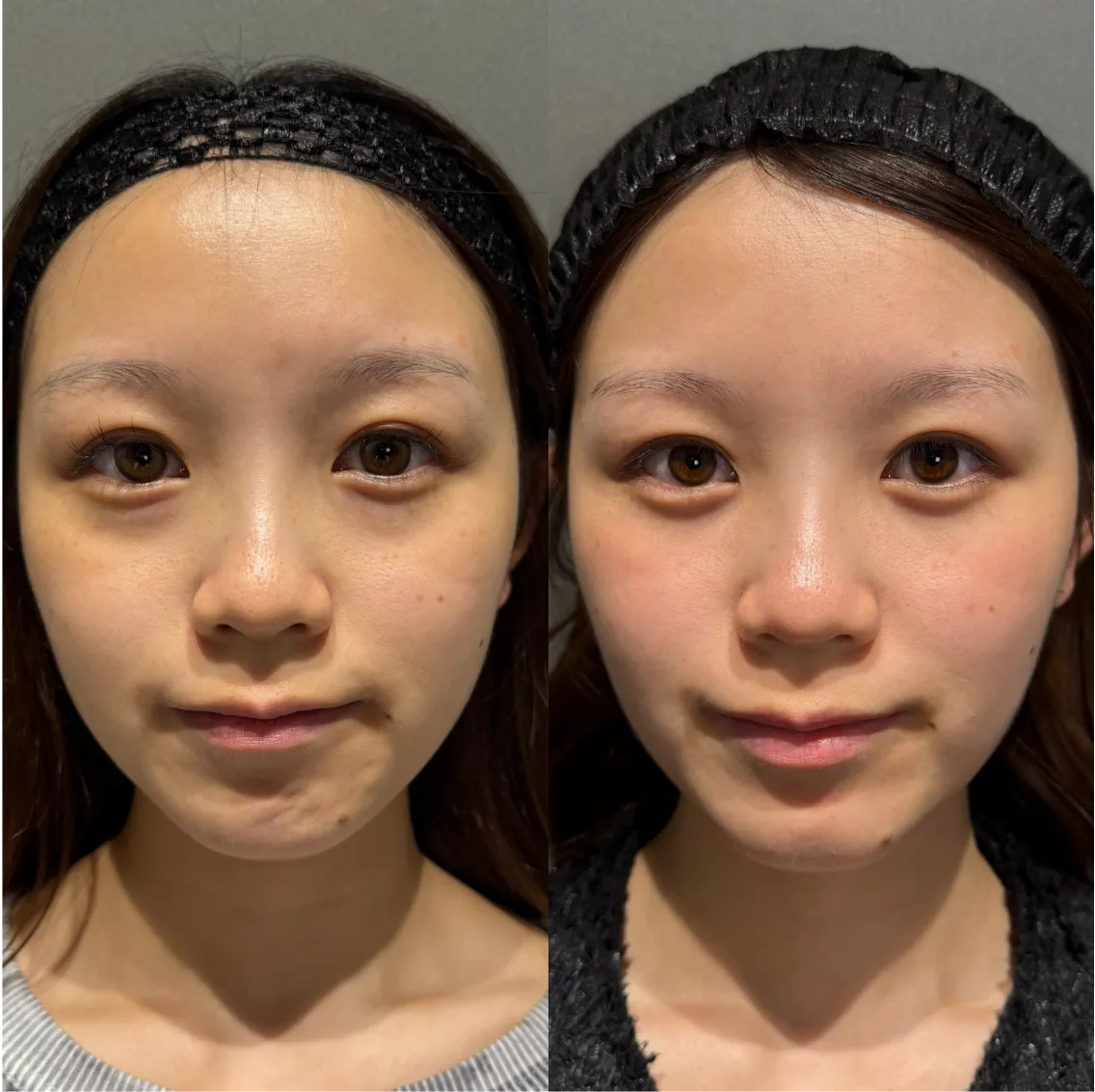 渋谷でのクマ取り脱脂症例比較：30代・40代女性の目袋の影解消事例