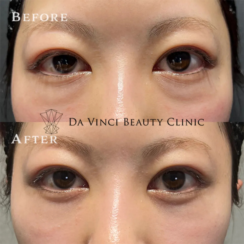 渋谷のクマ取り名医による20代女性の目の下のクマ取り・ふくらみ取り症例写真