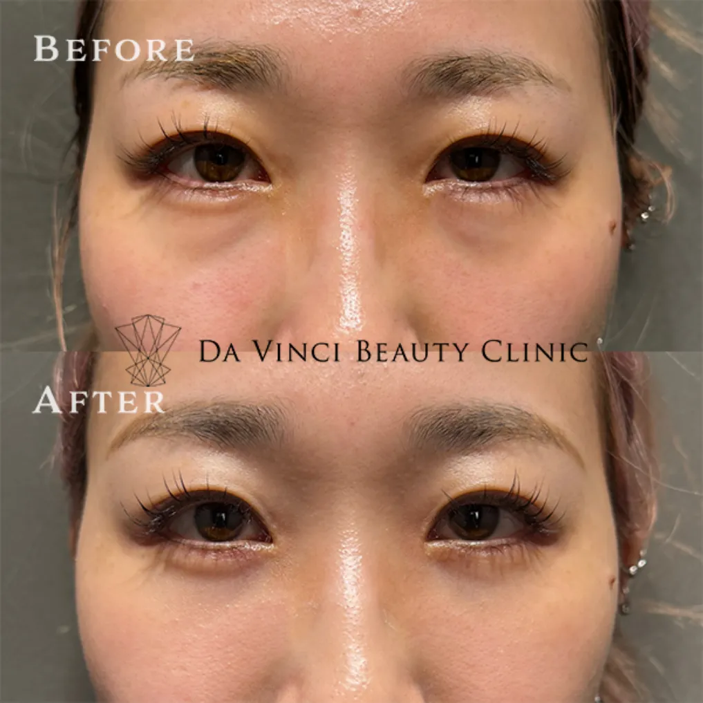 30代の疲れ顔を解消する目の下のふくらみ取り（経結膜脱脂）の症例ビフォーアフター