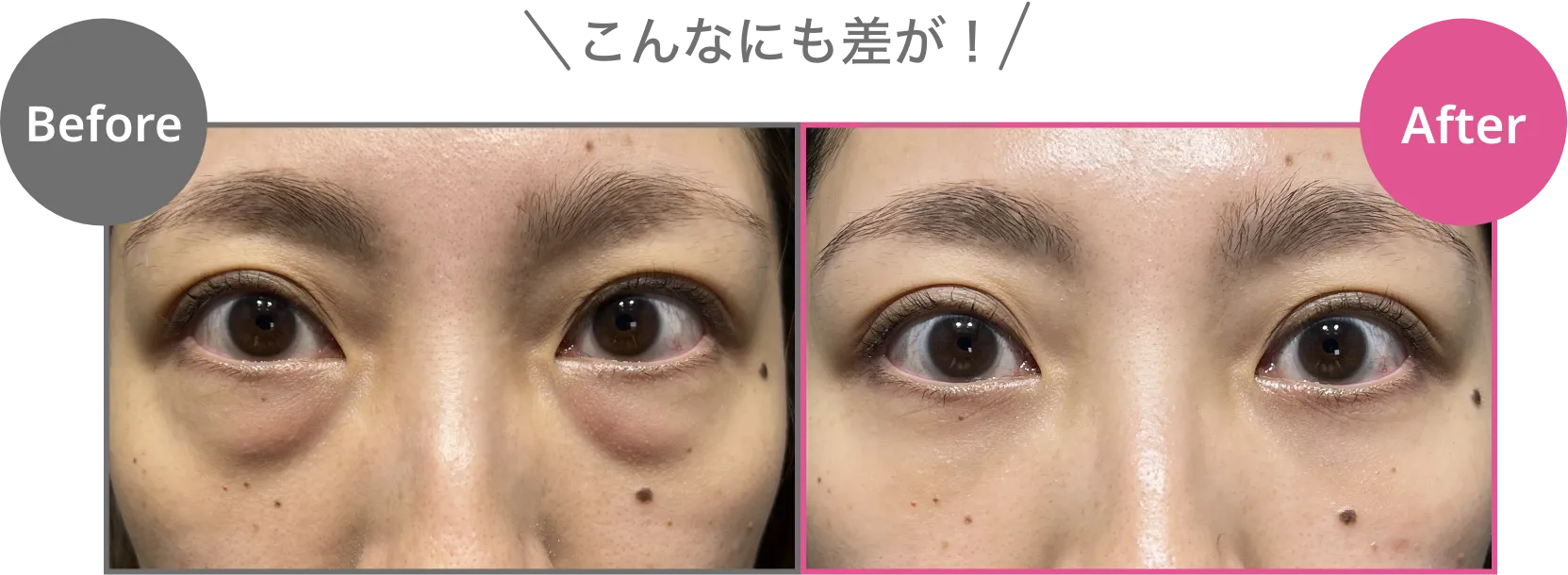 目の下にクマがある状態　通常の目元　こんなにも差が