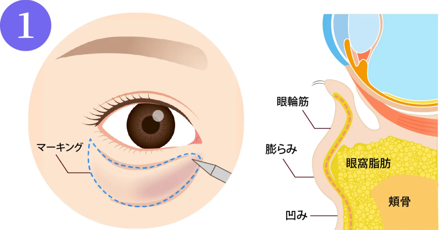 目元の膨らみと皮膚のたるみ、凹みの気になる箇所をマーキングします。