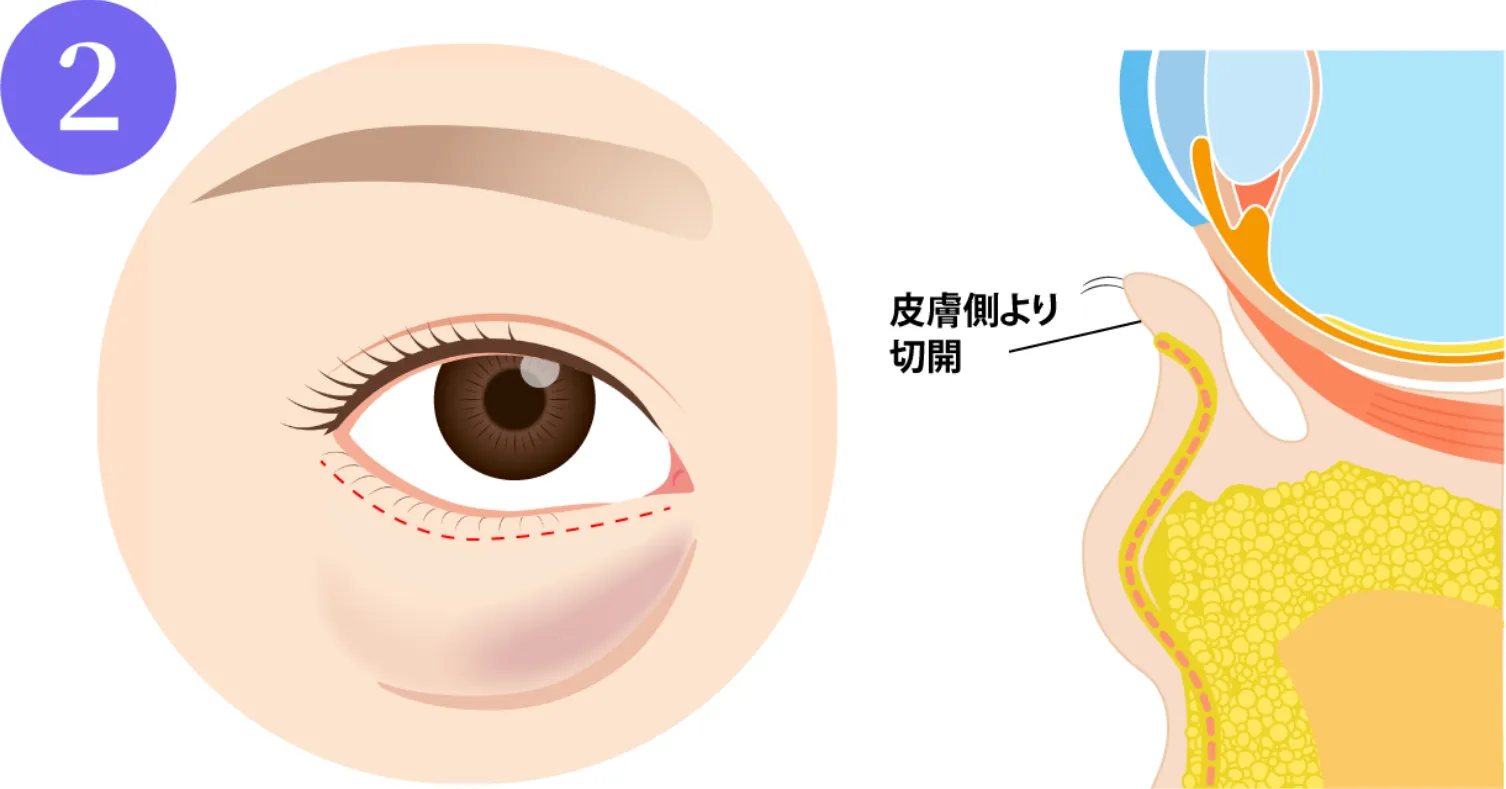 下まぶたのまつ毛の数ミリ下からメスを入れていきます。