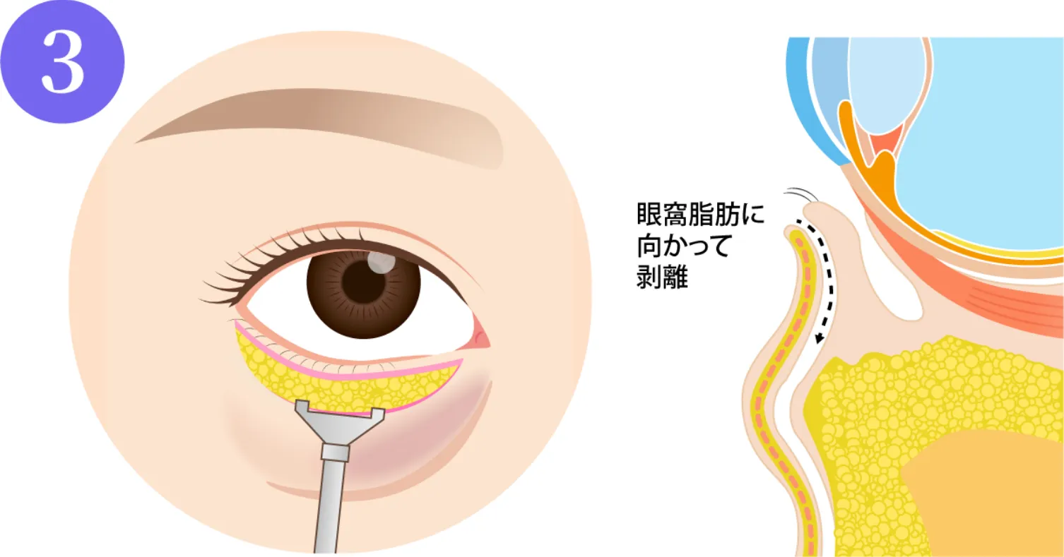 眼輪筋（目のまわりの筋肉）と眼窩脂肪を剥離していきます。