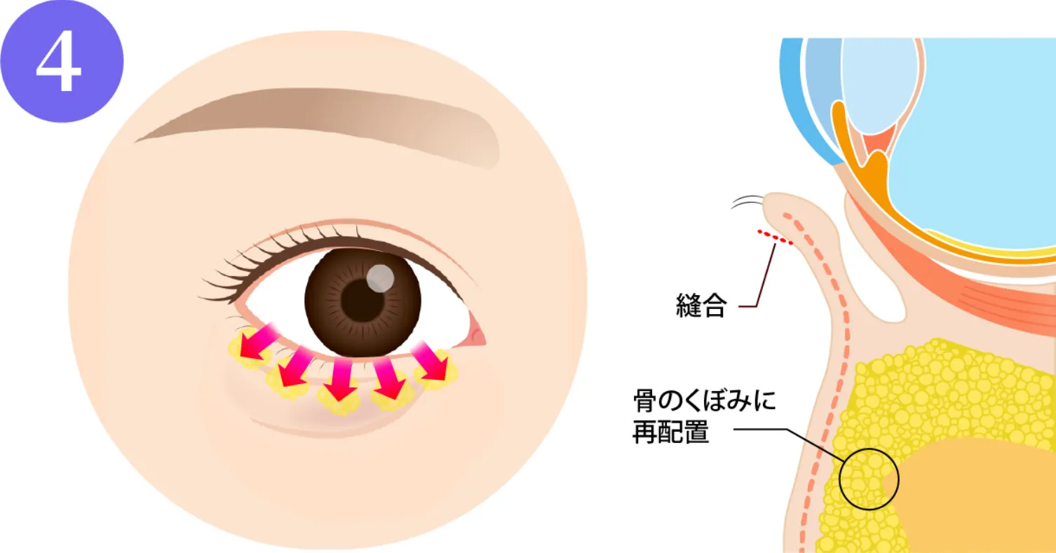 余分な脂肪を目の下の骨にある凹みに移動させ、平坦にならして固定します。シワの原因となる余っている皮膚を切除します。