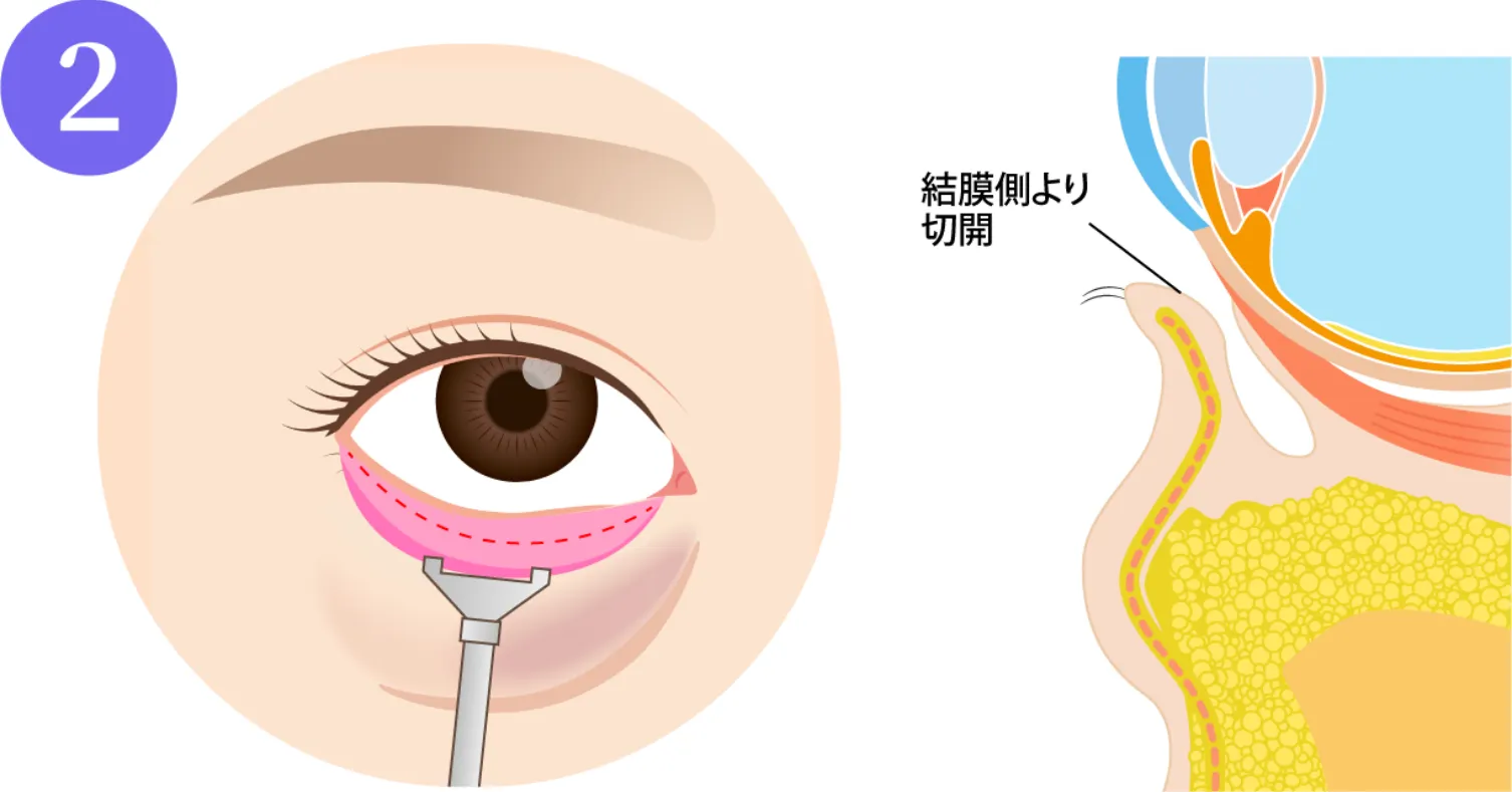 下まぶたをひっくり返し、裏側（内側）からメスを入れていきます。