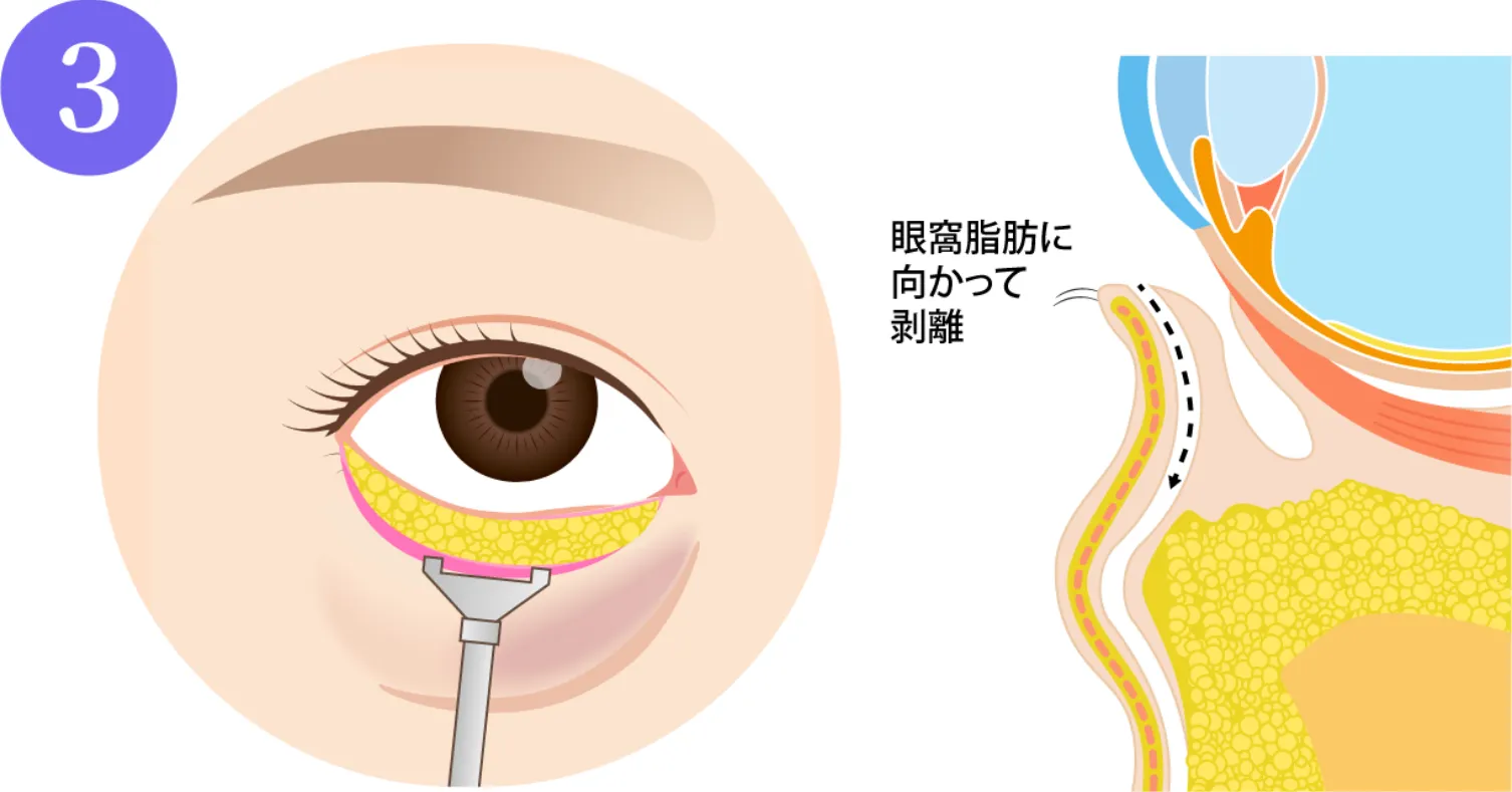 眼輪筋（目のまわりの筋肉）と眼窩脂肪を剥離していきます。