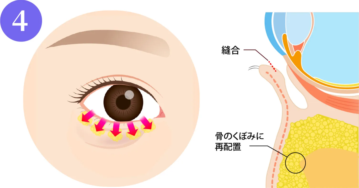 余分な脂肪を目の下の骨にある凹みに移動させ、平坦にならして固定します。