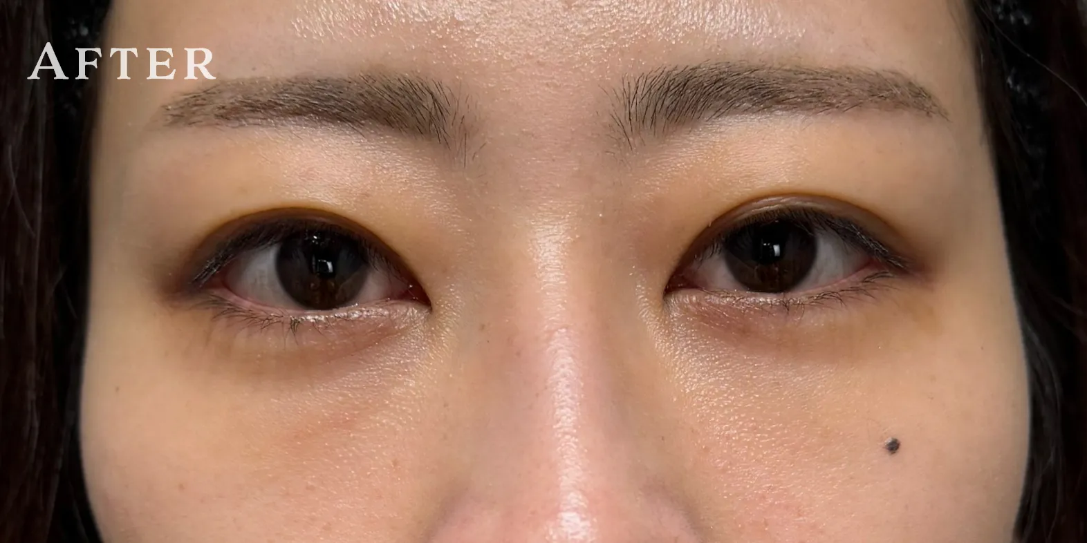 ハムラ法 Pick Up症例 CASE01 AFTER