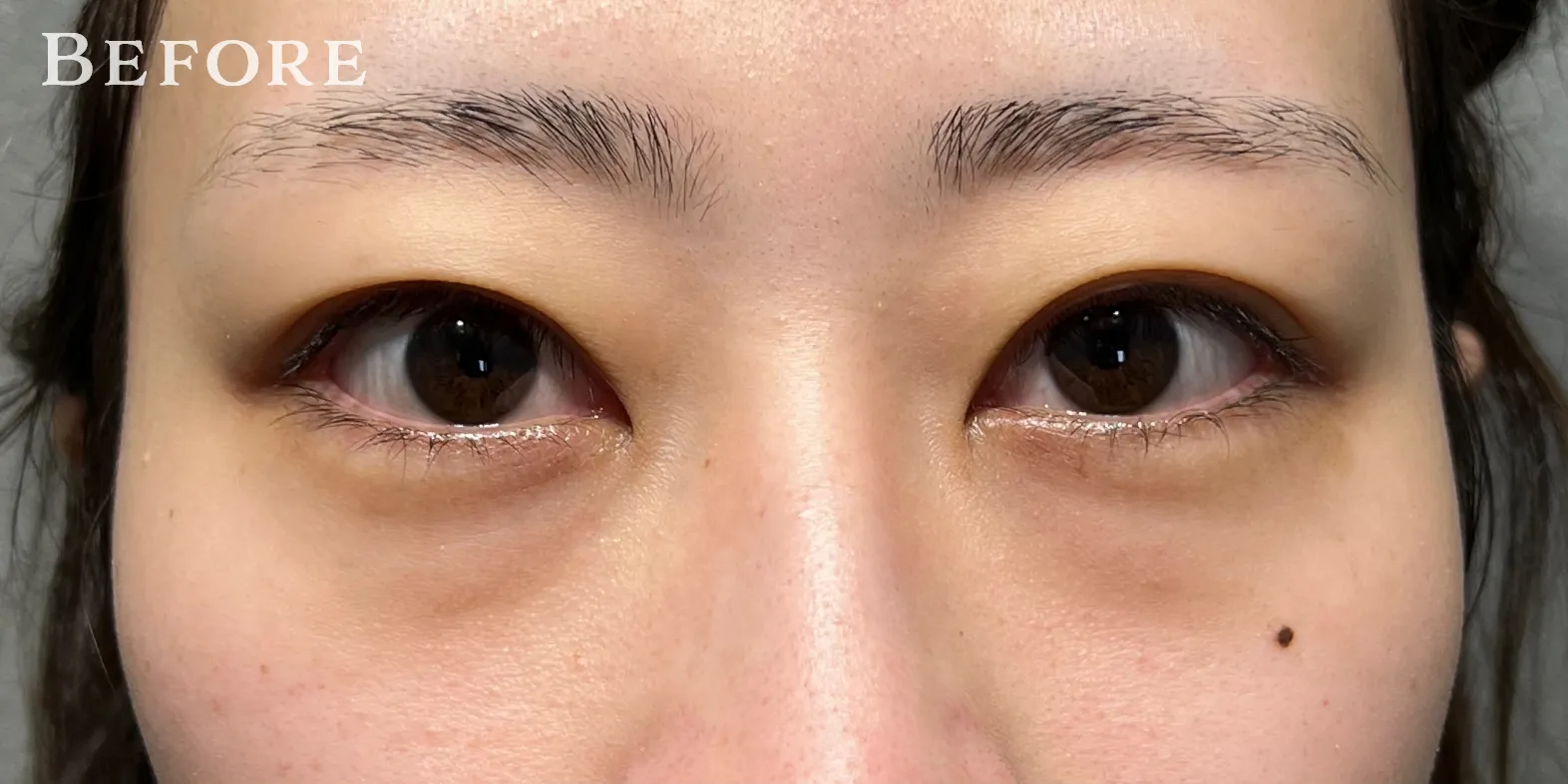 ハムラ法 Pick Up症例 CASE01 BEFORE