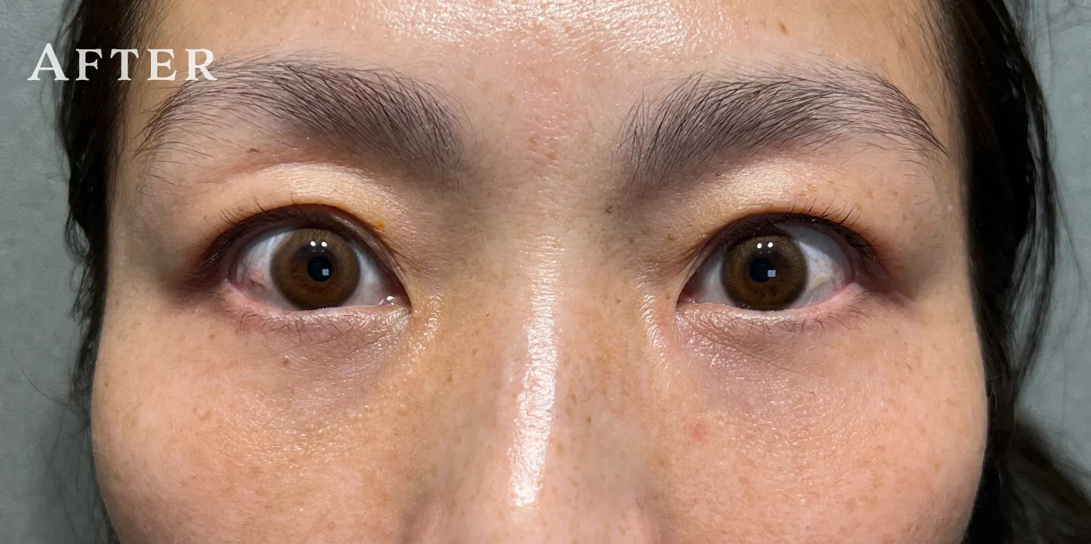 ハムラ法 Pick Up症例 CASE02 AFTER