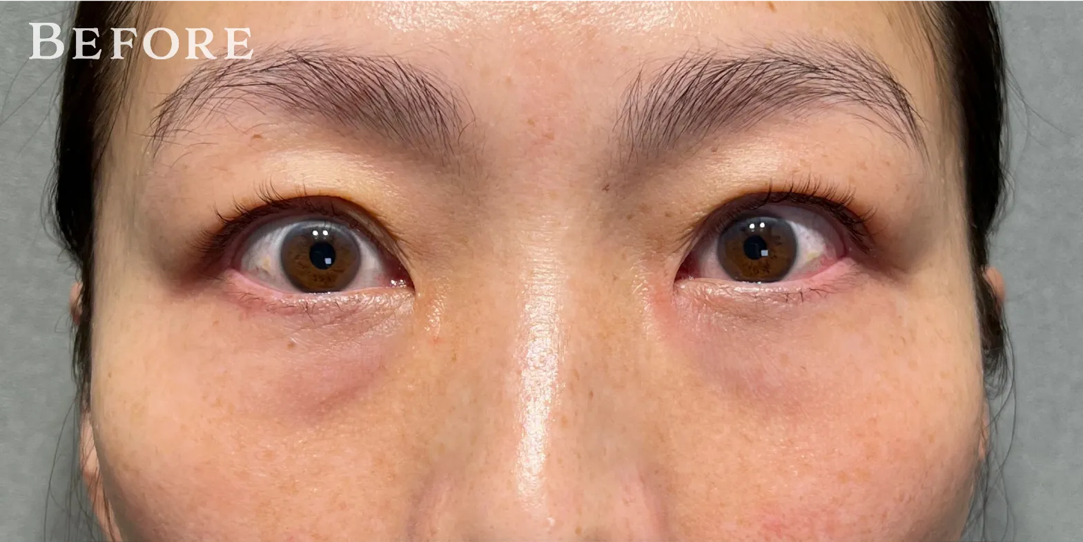 ハムラ法 Pick Up症例 CASE02 BEFORE