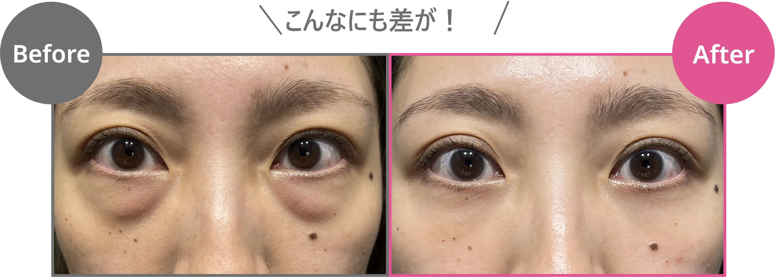 目の下のクマ取り症例比較（Before/After）。目袋のふくらみを平らに整えた変化を確認。