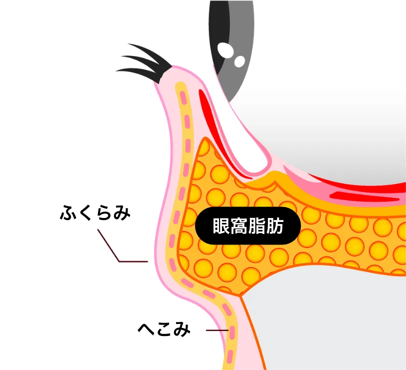 黒クマの構造と原因を解説した図解。脂肪のふくらみとその下のへこみが生じる理由を詳説。