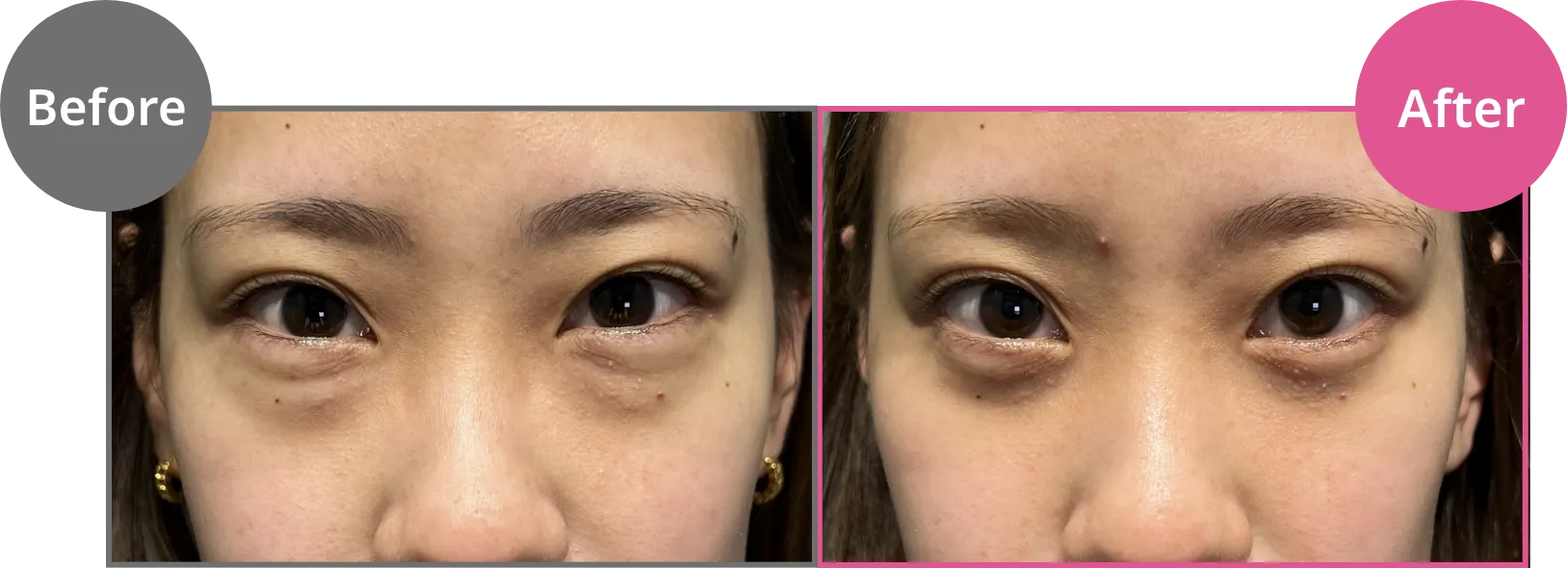 目の下にクマがある状態　通常の目元　こんなにも差が