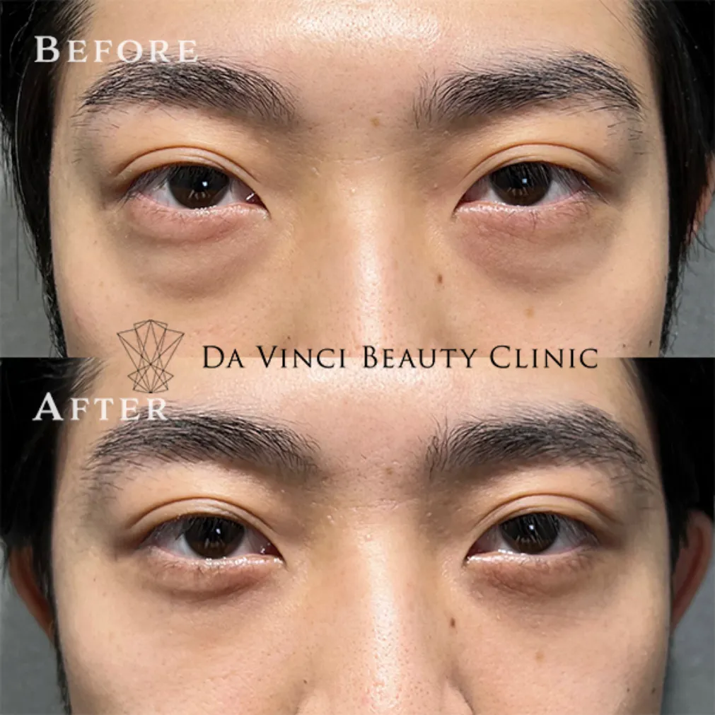 20代男性 目の下の切らないクマ取り術前・術後の比較症例写真