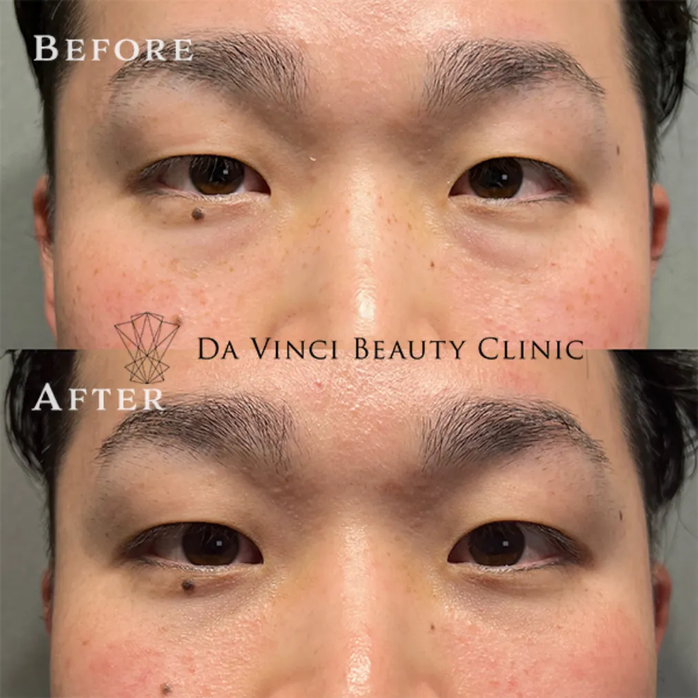 30代男性 目の下の切らないクマ取り術前・術後の比較症例写真